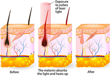 Laser Hair Removal Winchester Electrology Laser Center